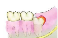 拔智齿会影响旁边的牙齿吗