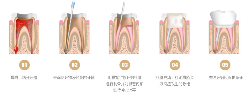 根管治疗是什么