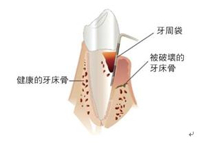 孕妇患牙周炎易引发早产