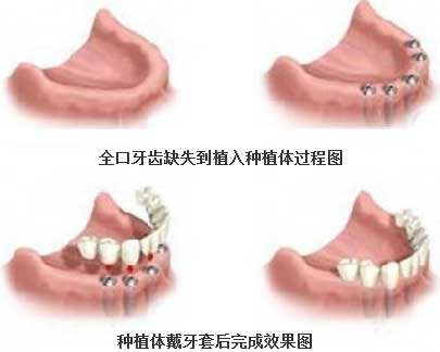 牙龈萎缩能做种植牙吗