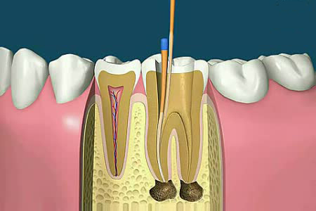 根管治疗