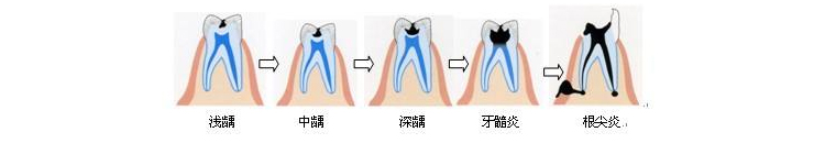 龋齿的危害