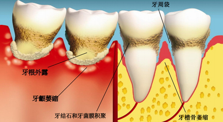 牙周炎