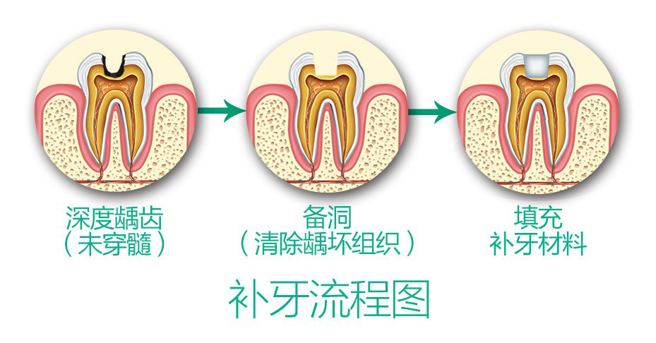 补牙流程