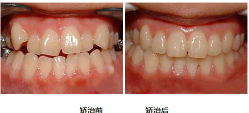 牙齿矫正