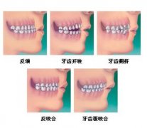 牙齿矫正大概多少钱