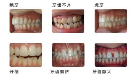 成都 矫正牙齿